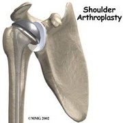 Shoulder joint surgery